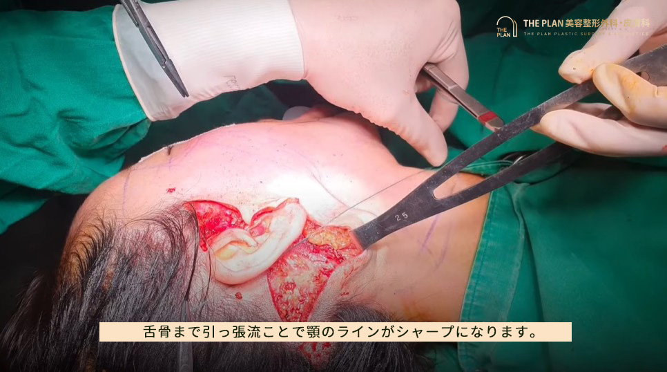 ザプラン美容整形外科の切開リフト手術写真