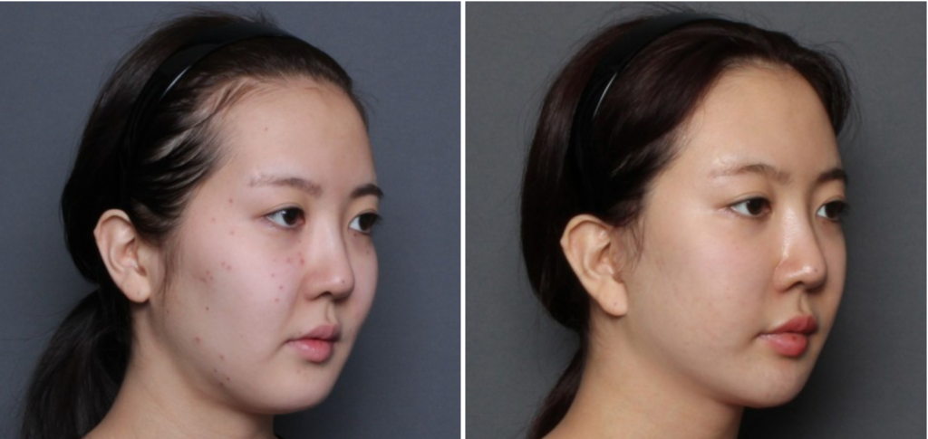 THEPLAN美容整形外科・皮膚科にて切開リフトを行った20代から30代の女性の横向きの写真
