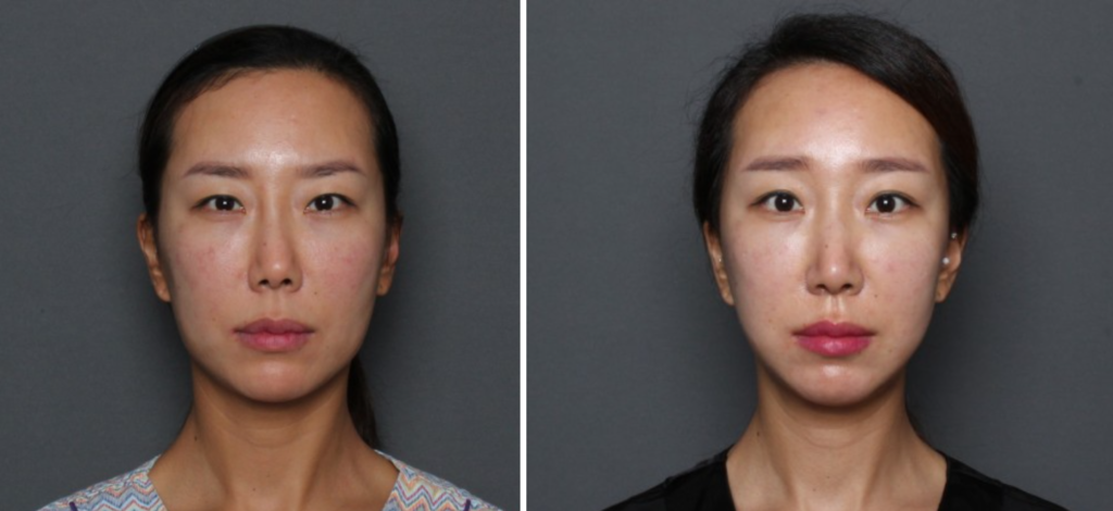 THEPLAN美容整形外科・皮膚科にて切開リフトを行った20代から30代の女性の正面の写真