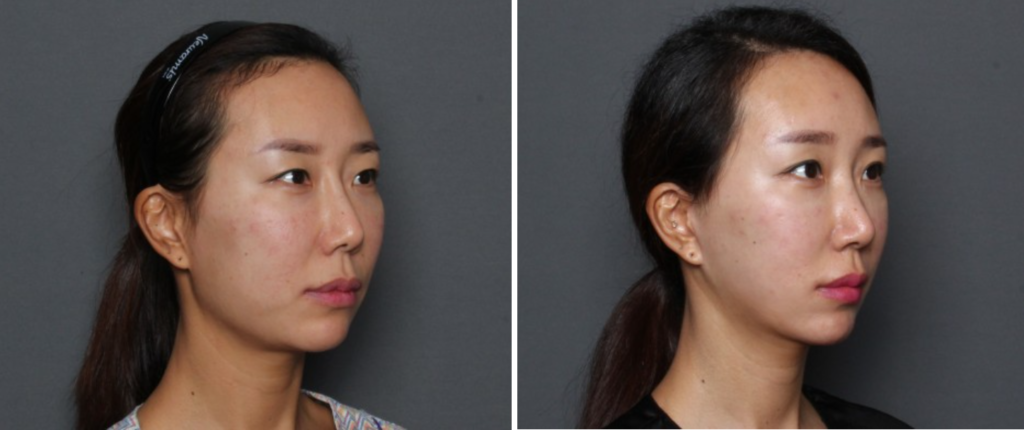 THEPLAN美容整形外科・皮膚科にて切開リフトを行った20代から30代の女性の横向きの写真