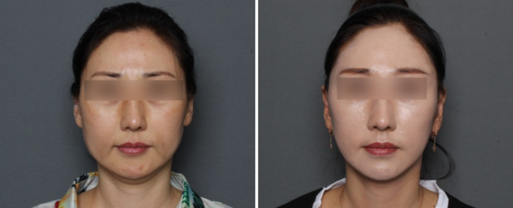 THEPLAN美容整形外科・皮膚科にて切開リフトを行った40代から50代の女性の正面の写真