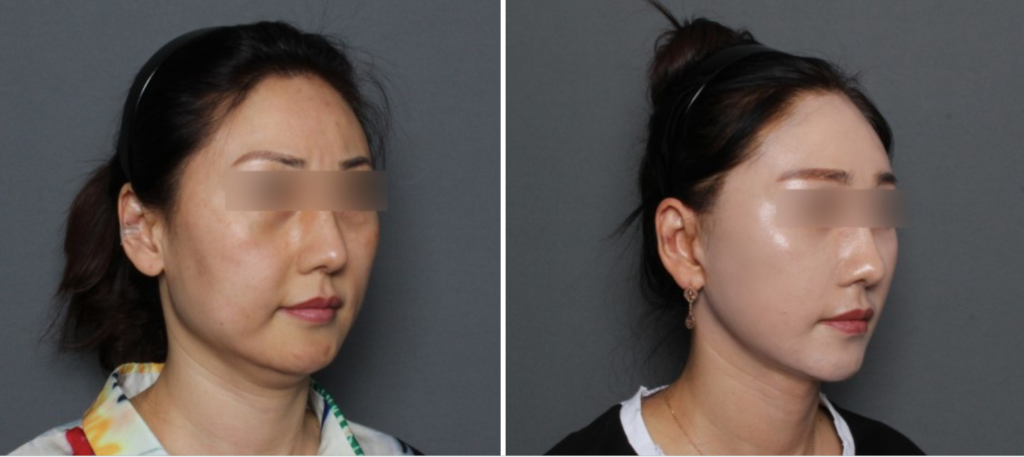 THEPLAN美容整形外科・皮膚科にて切開リフトを行った40代から50代の女性の横向きの写真