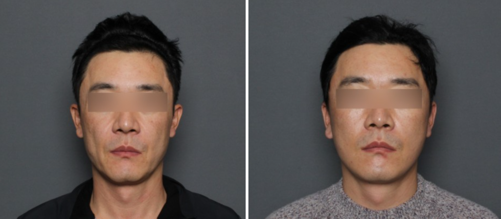 THEPLAN美容整形外科・皮膚科にて切開リフトを行った40代から50代の男性の正面の写真