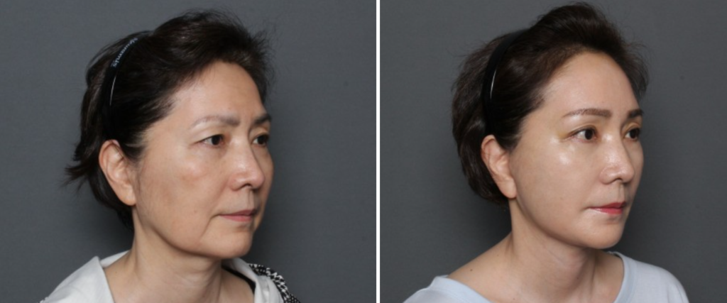 THEPLAN美容整形外科・皮膚科にて切開リフトを行った60代から70代の女性の横向きの写真