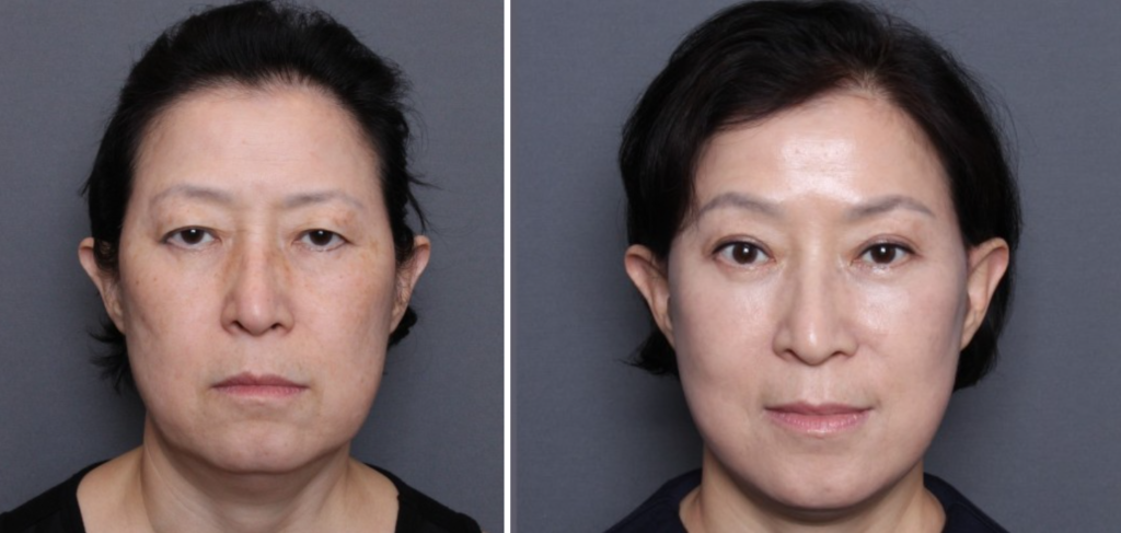 THEPLAN美容整形外科・皮膚科にて切開リフトを行った60代から70代の女性の正面の写真