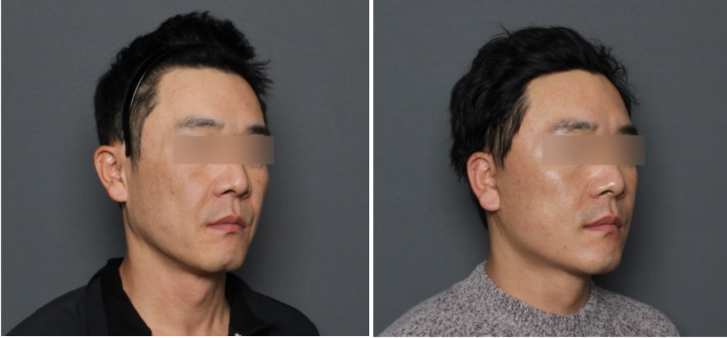 THEPLAN美容整形外科・皮膚科にて切開リフトを行った40代から50代の男性の横向きの写真