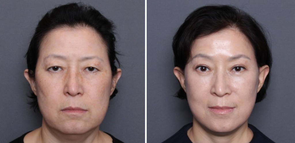 THEPLAN美容整形外科・皮膚科にて切開リフトを行った60代から70代の女性の正面の写真