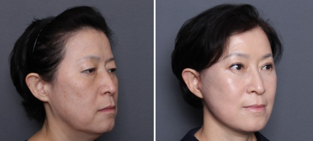 THEPLAN美容整形外科・皮膚科にて切開リフトを行った60代から70代の女性の横向きの写真