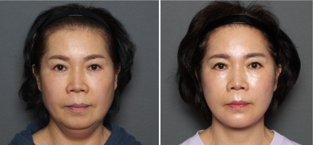 THEPLAN美容整形外科で切開リフトを受けた62 歳女性の正面写真