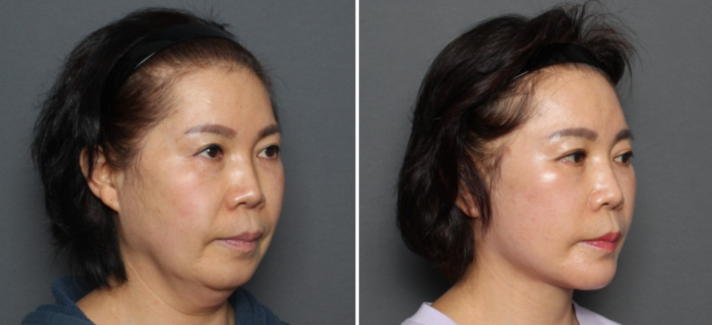 THEPLAN美容整形外科で切開リフトを受けた62 歳女性の横向きの写真