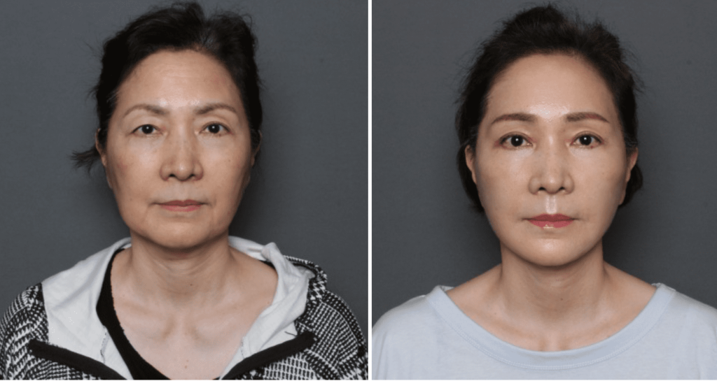 THE PLAN美容整形外科で切開リフトを受けた女性の手術前と手術後の比較写真(正面)