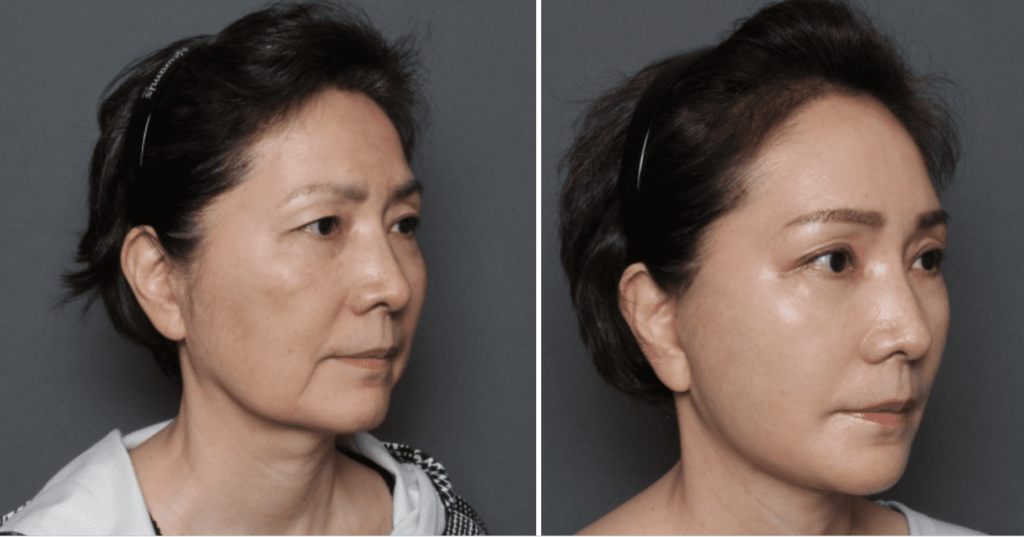 THE PLAN美容整形外科で切開リフトを受けた女性の手術前と手術後の比較写真(横向き)