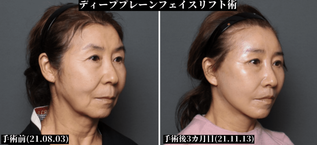 THEPLAN美容整形外科で切開リフトを受けた63歳女性の横向き写真
