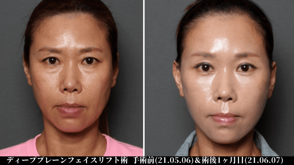 THE PLAN美容整形外科で切開リフトを受けた女性の症例写真