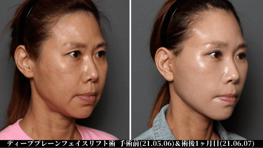 THE PLAN美容整形外科で切開リフトを受けた女性の症例写真