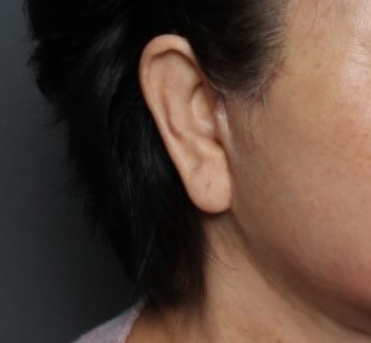THE PLAN美容整形で切開リフトの再手術を受けた女性の手術前と術後の変化の症例写真